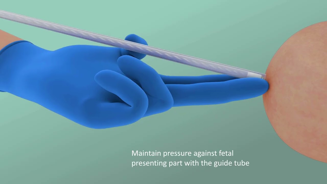 Goltrace Fetal Spiral Electrode (FSE)