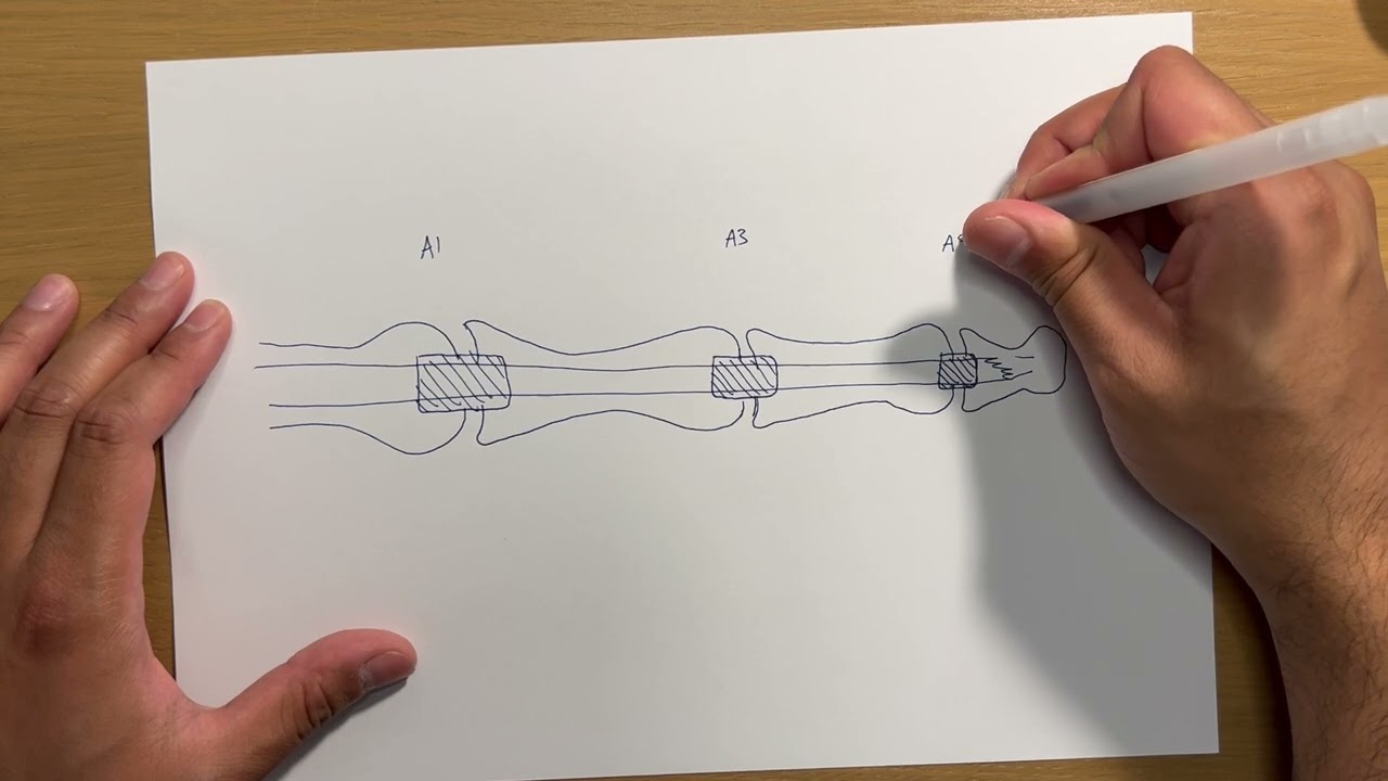 Hands for the FRCS (Tr & Orth) - Flexor Pulley System