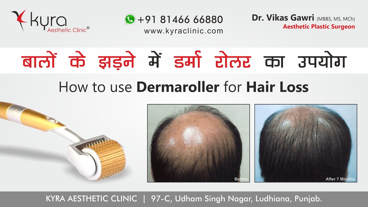 Treatment for Hair Thinning or Hair Loss in hindi