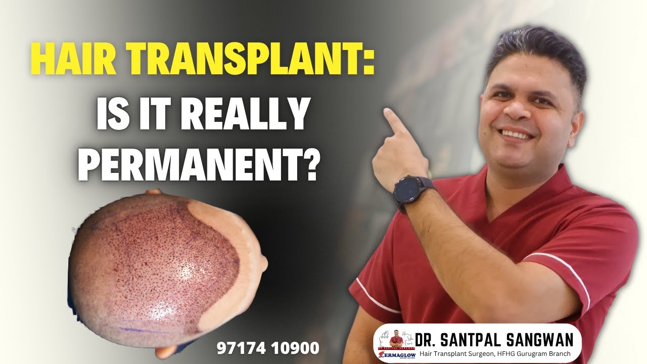 Will My Hair Transplant Last Forever? Real Truth About Hair Transplants by Dr. Santpal Sangwan