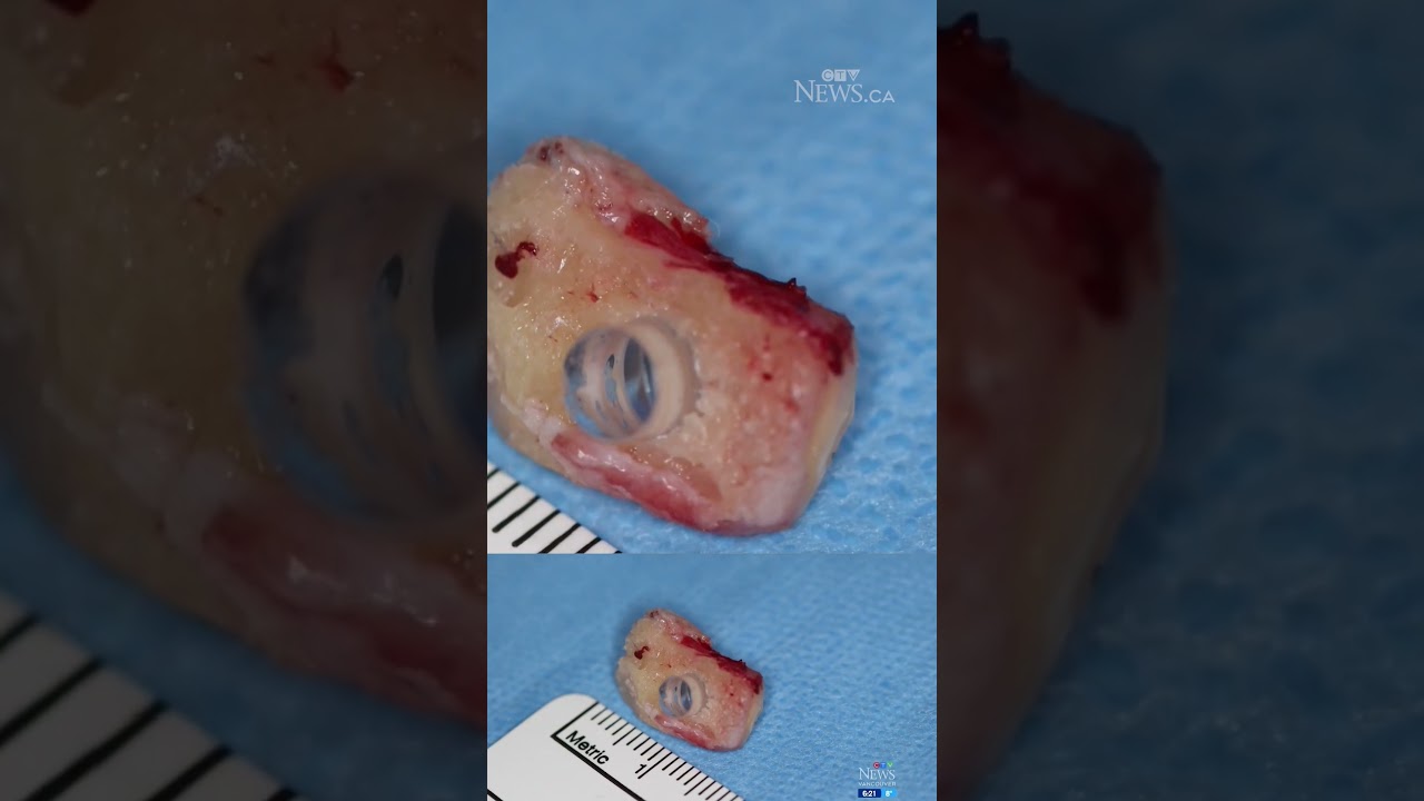 Canada&rsquo;s first tooth-in-eye surgery could restore North Vancouver man&rsquo;s vision