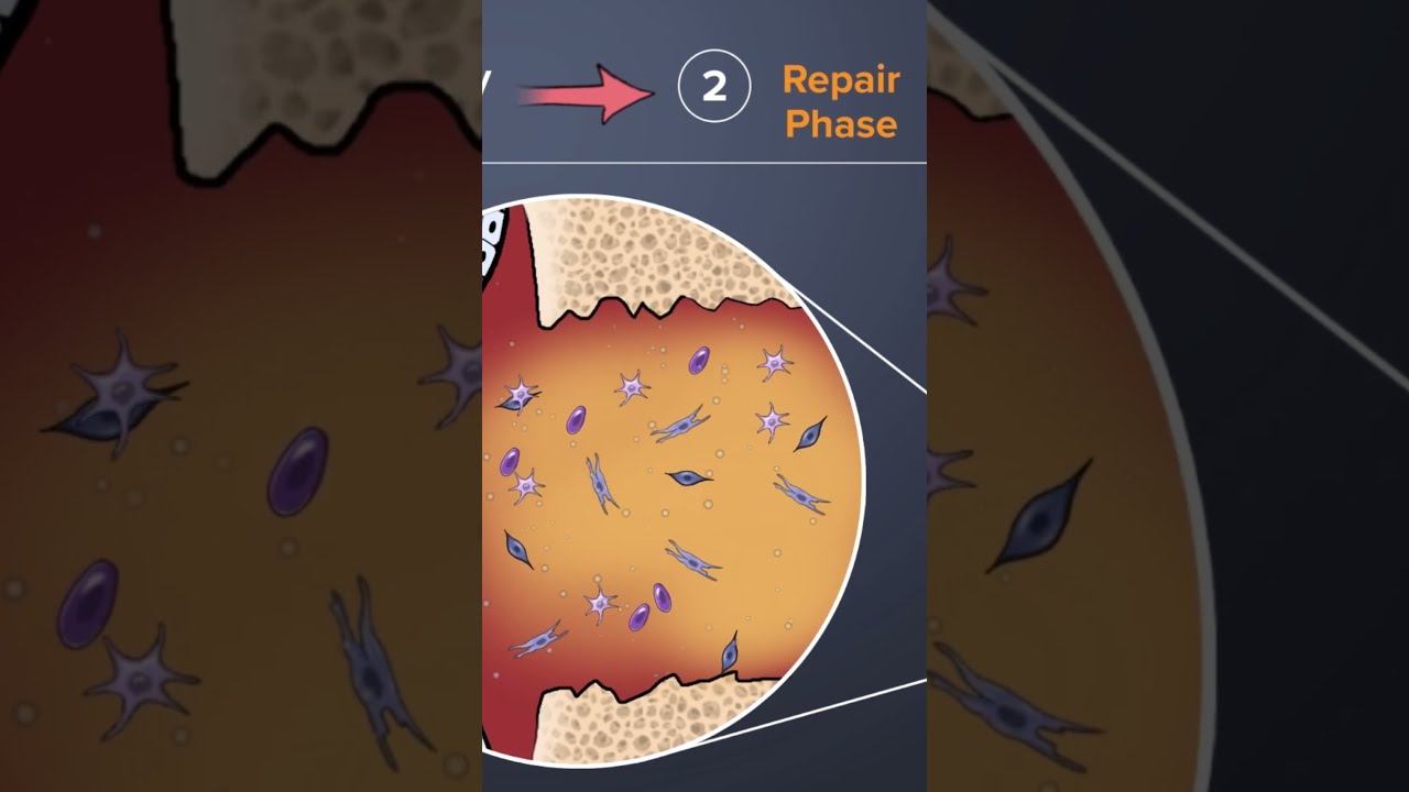 Lumbar Fusion Surgery Bone Healing Stages