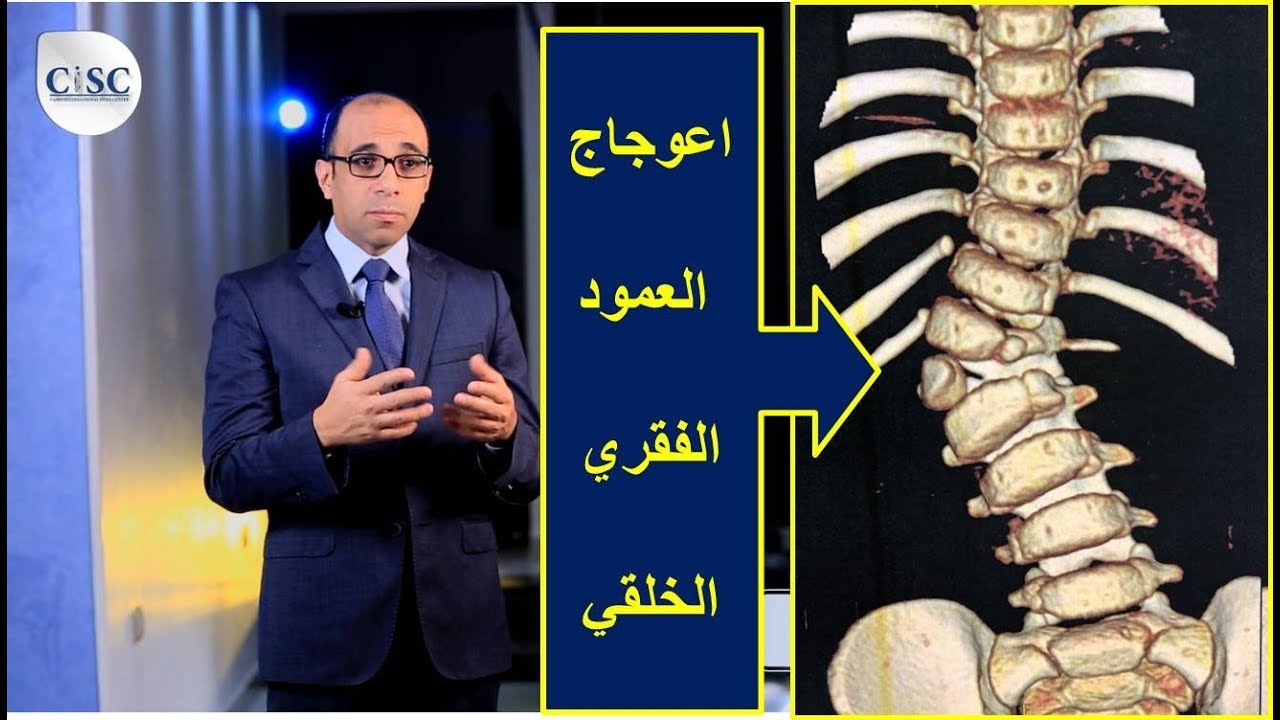 اعوجاج العمود الفقري الخلقي، علاجة مختلف عن الاعوجاج التلقائي