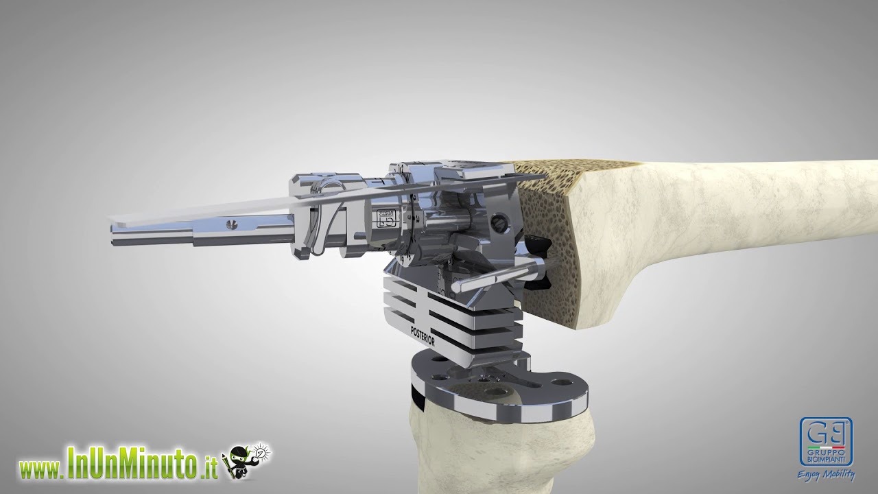 Video animazione 3D Chirurgia Protesica Ginocchio