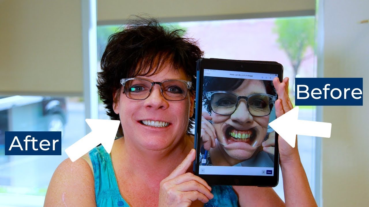 Dental Implants Case Study. You're Worth It!