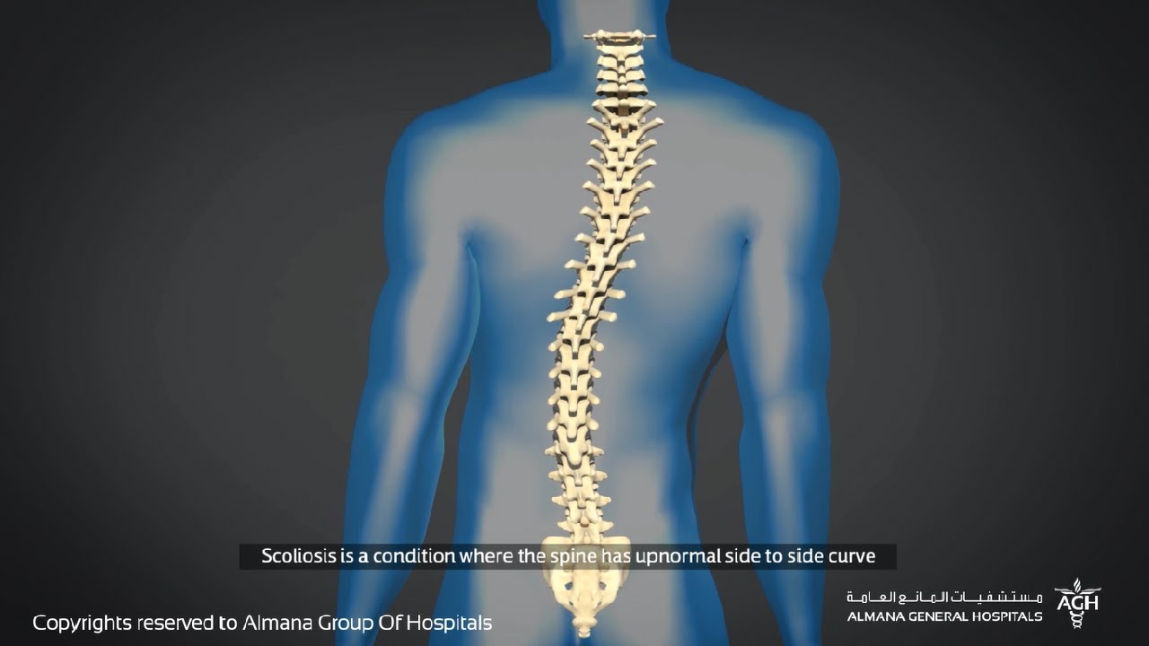 ما هو الجنف؟ و كيف يتم اجراء الجراحة التصحيحية؟