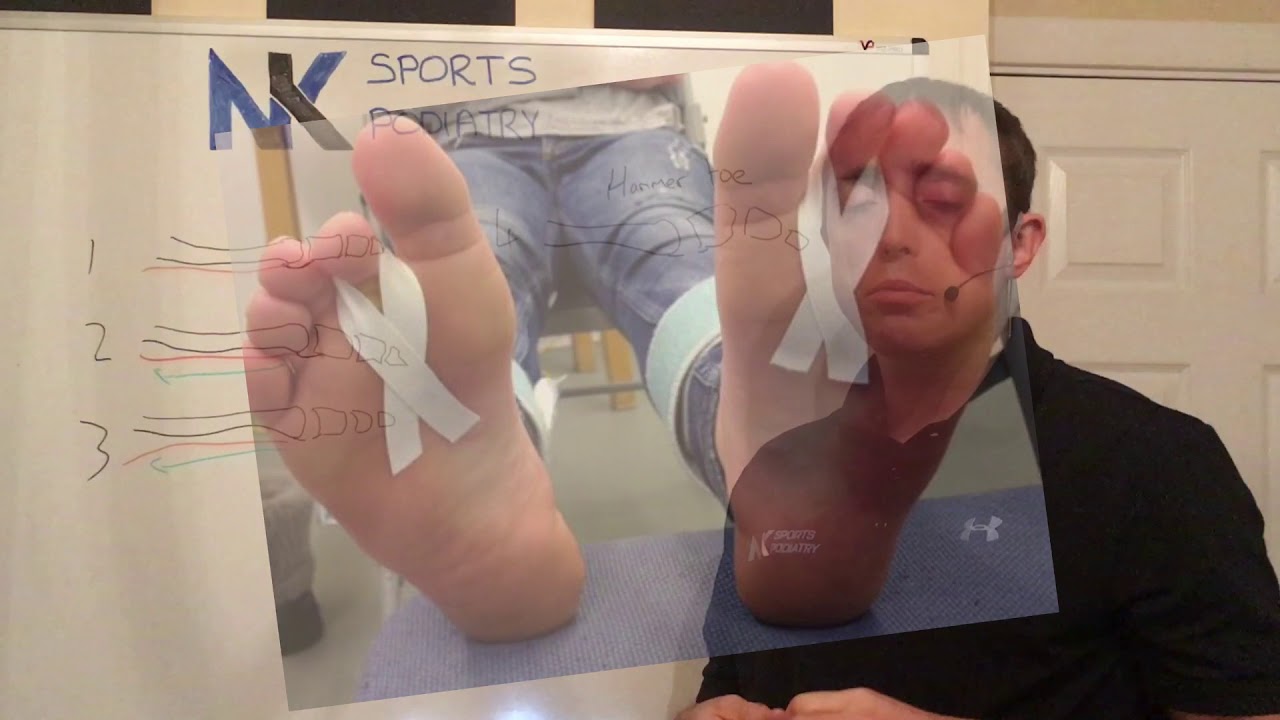 Plantar Plate injuries | Injury