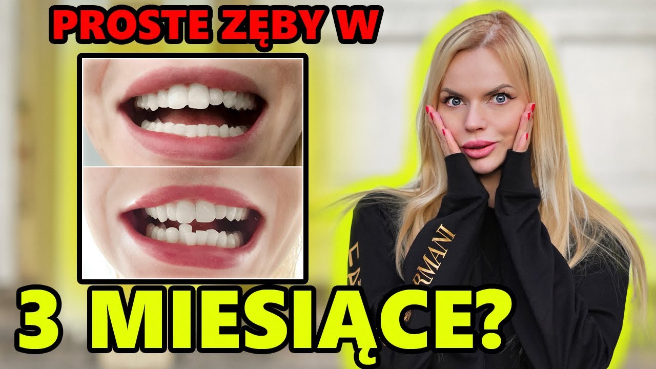 Aparat invisalign CZY WARTO? Efekty przy 20 nakładce