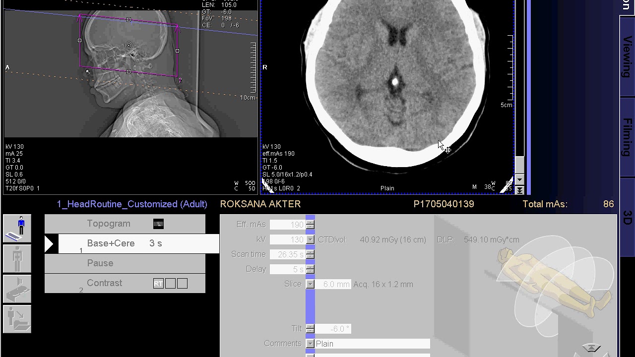 how to make ct scan of mastoid (SIEMENS) in syngo acquisition workplace.