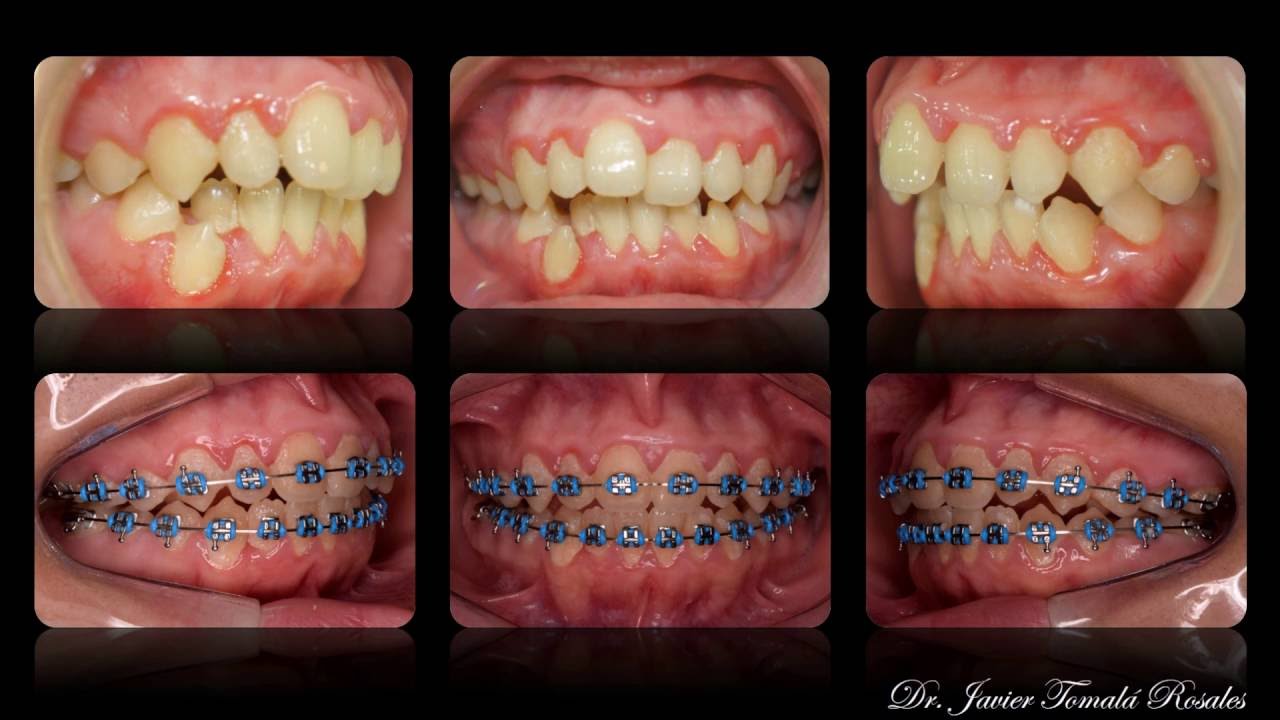 ORTODONCIA ANTES Y DESPUÉS, APIÑAMIENTO  DR. JAVIER TOMALÁ ROSALES