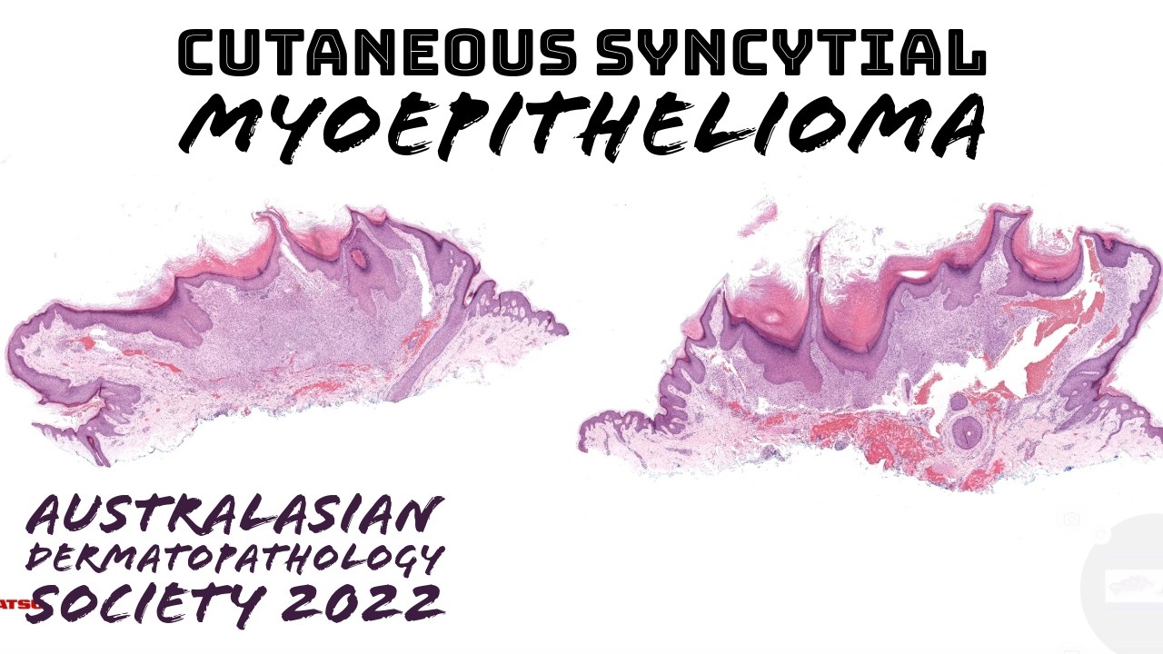 Cutaneous Syncytial Myoepithelioma (S100 & EMA +, Keratin -, EWSR1::PBX3 gene fusion) pathology