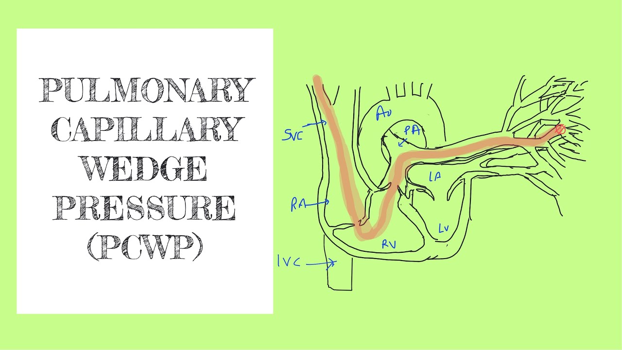 Pulmonary capillary wedge pressure (PCWP)