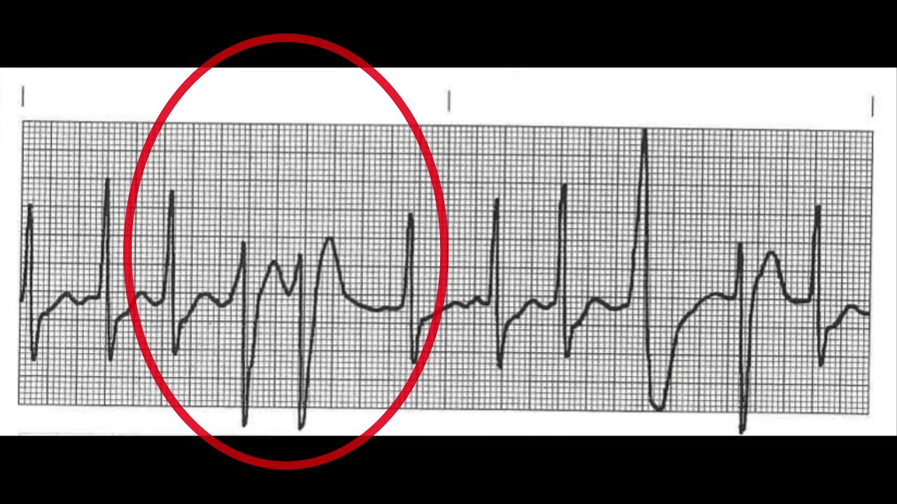 10 Ventricular Beats & Rhythms