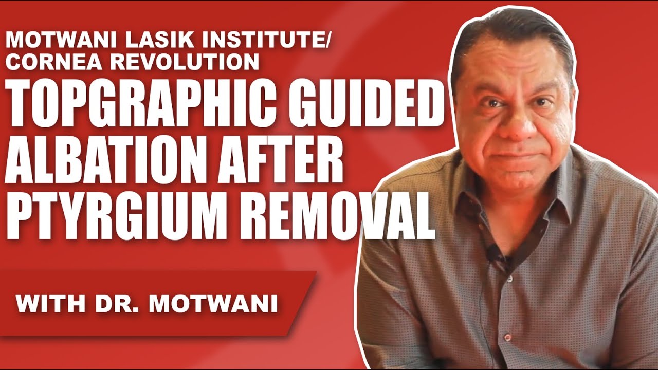 Topographic Guided Ablation of Irregular Astigmatism after Ptyrgium Removal by Dr. Manoj Motwani