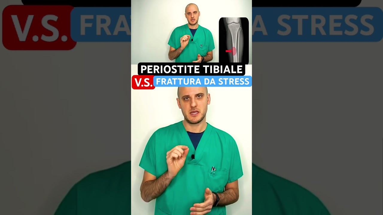 PERIOSTITE TIBIALE 🆚 FRATTURA DA STRESS