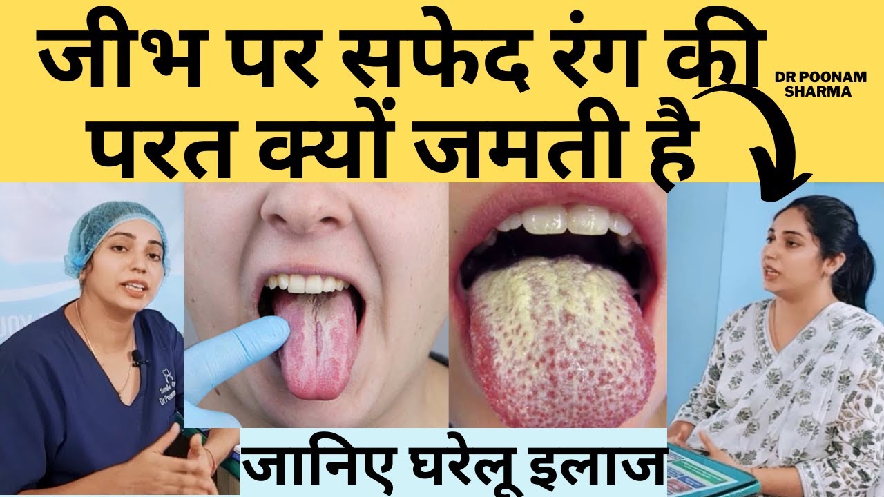 जीभ पर सफेद रंग की परत का जमना जानिए कारण और इलाज||Oral Thrush||जीभ पर सफेद रंग की परत का इलाज