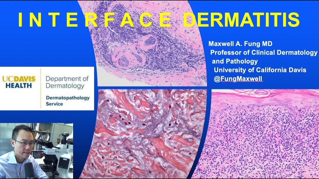 DERMATOPATHOLOGY: Interface Dermatitis