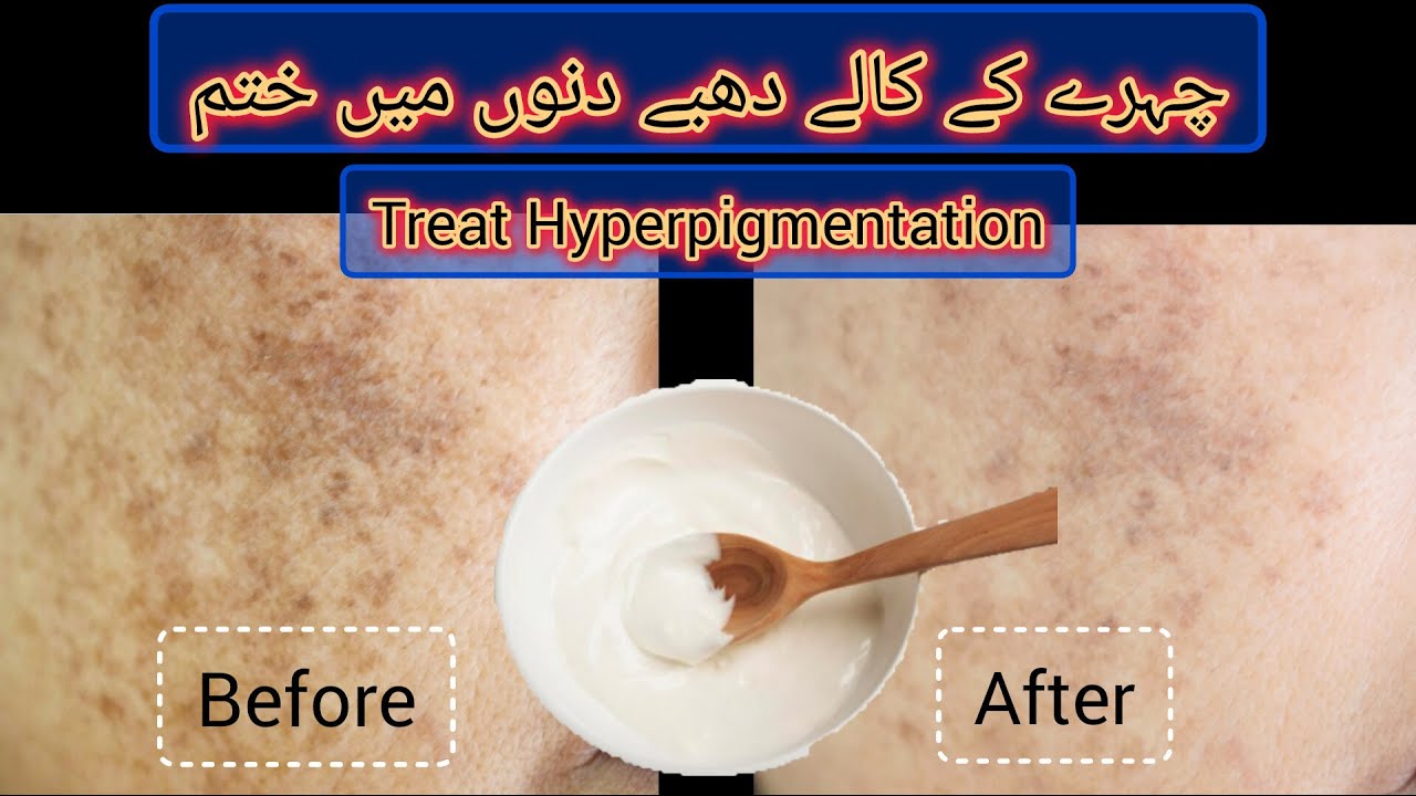 Dark Spots Aur Pigmentation Ka Gharelu Ilaj | Instant Glow Face Pack | Home Remedies