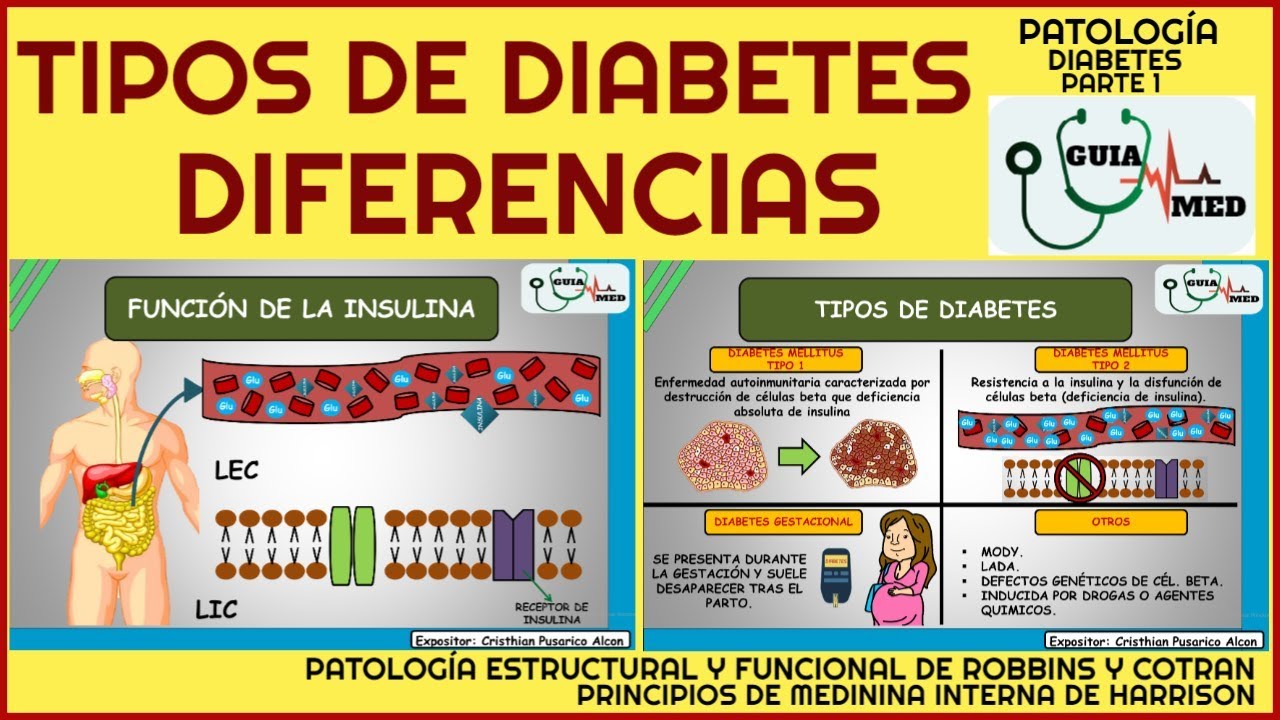 TIPOS DE DIABETES Y SUS DIFERENCIAS | GuiaMed