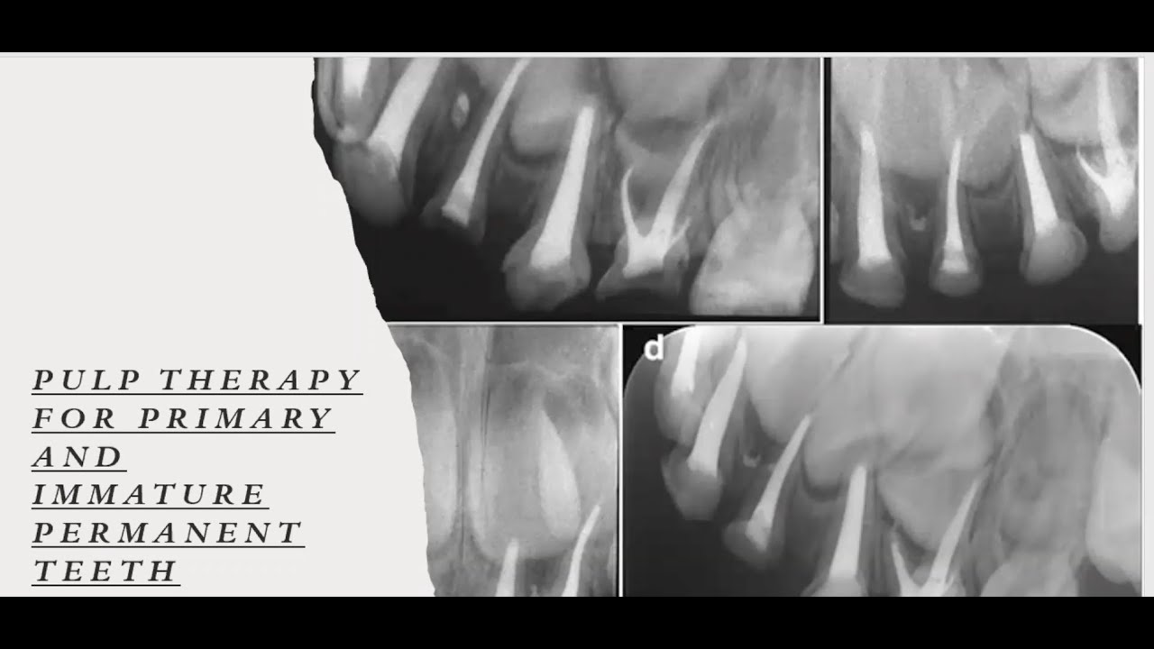 Pulp Therapy for Primary and Immature Primary Teeth