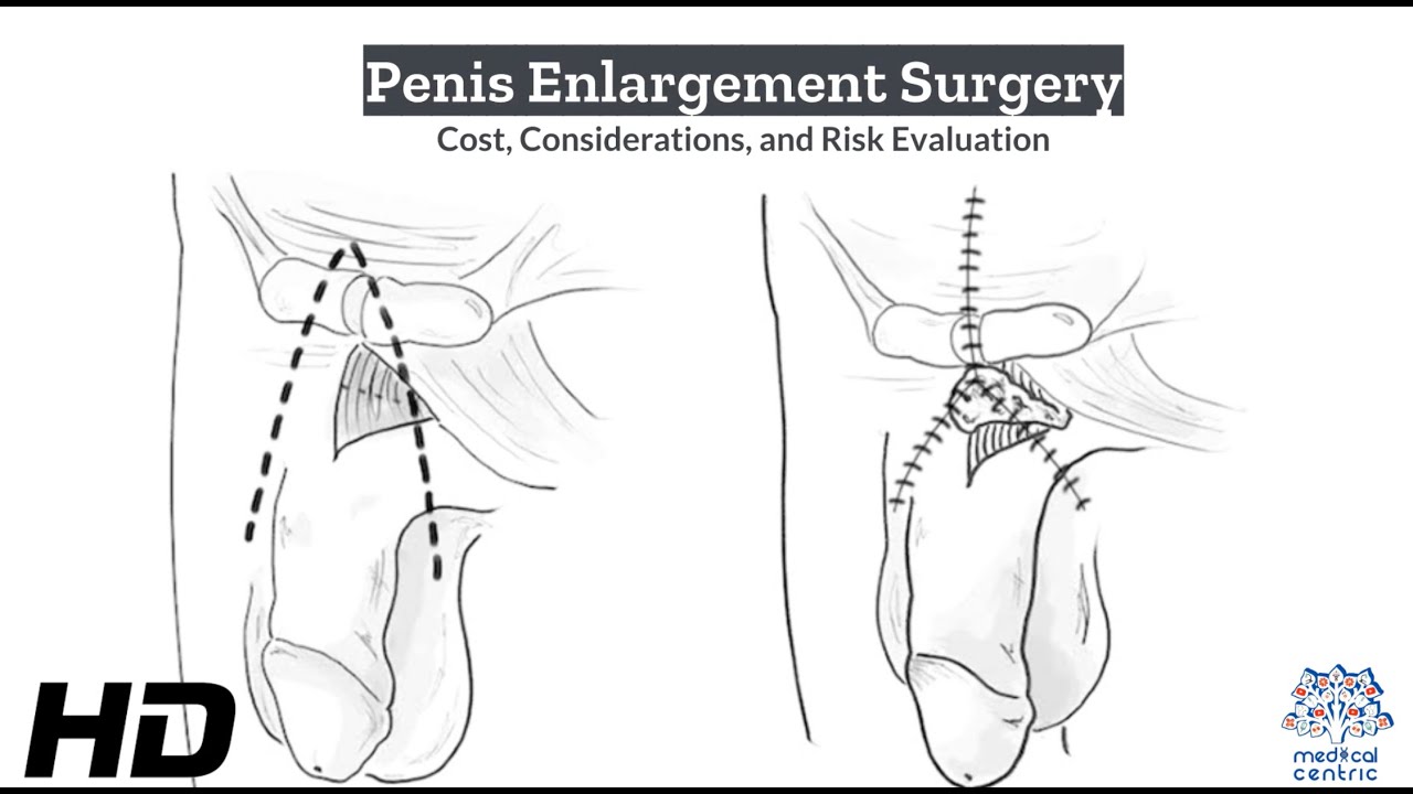 Is Penis Enlargement Surgery Worth the Risk? Pros and Cons