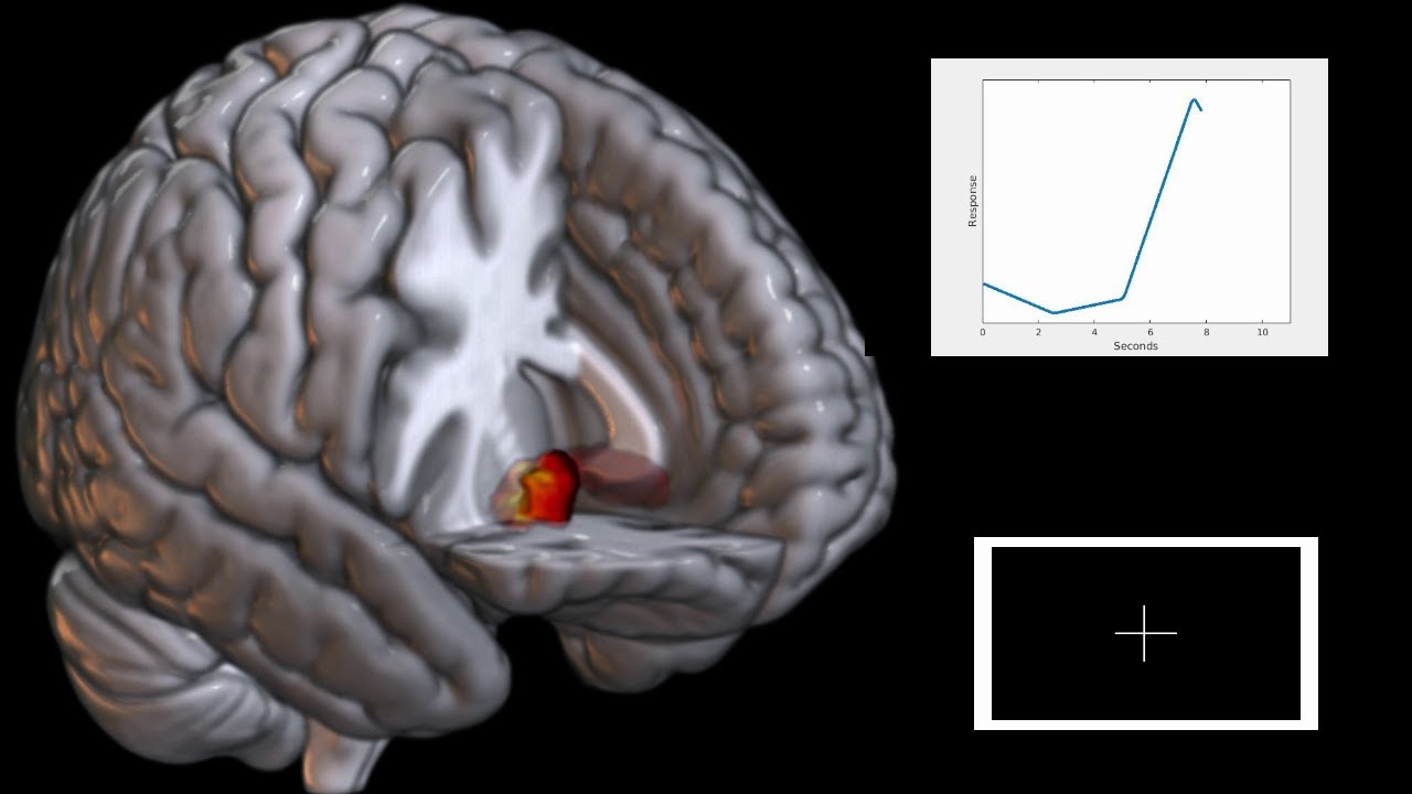Imaging the anticipation of reward using fMRI and the Monetary Incentive Delay task