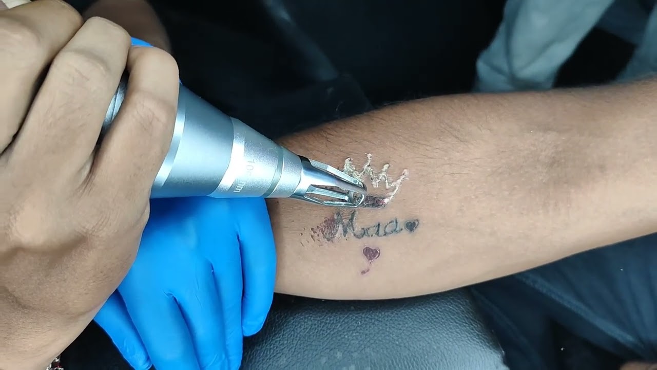 Laser Tattoo removal in Ahmedabad, How to remove tattoo/ Mo- 84018 11794 