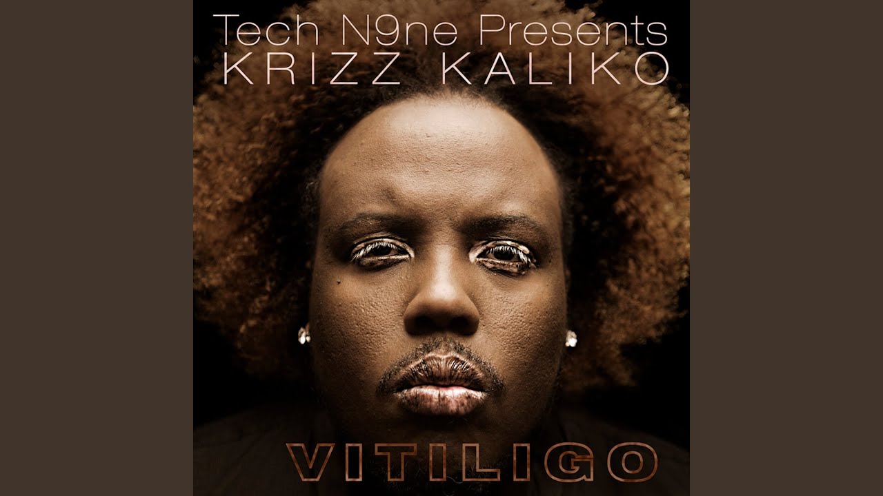 Vitiligo