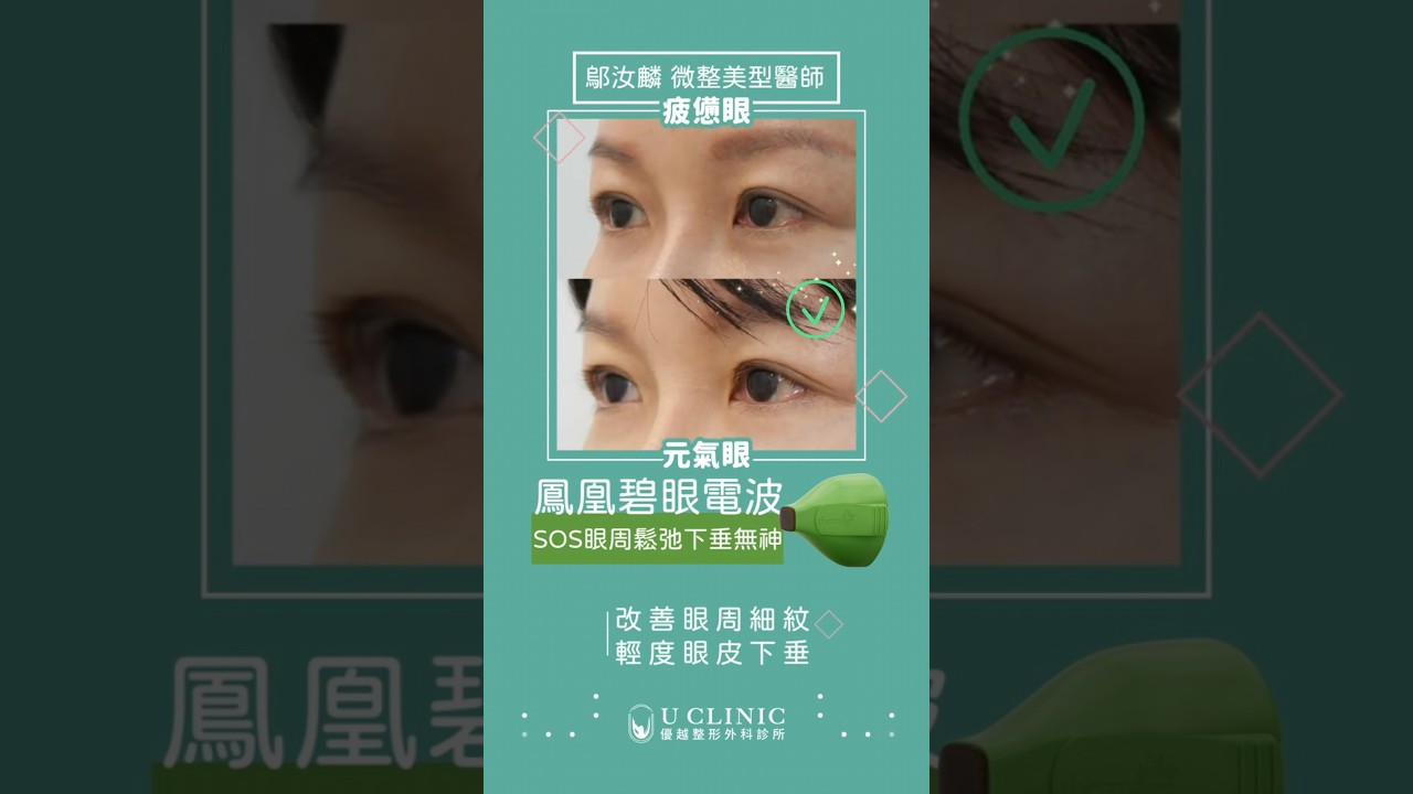 【鳳凰碧眼電波】不是特效！這是眼睛打完一半的真實差異