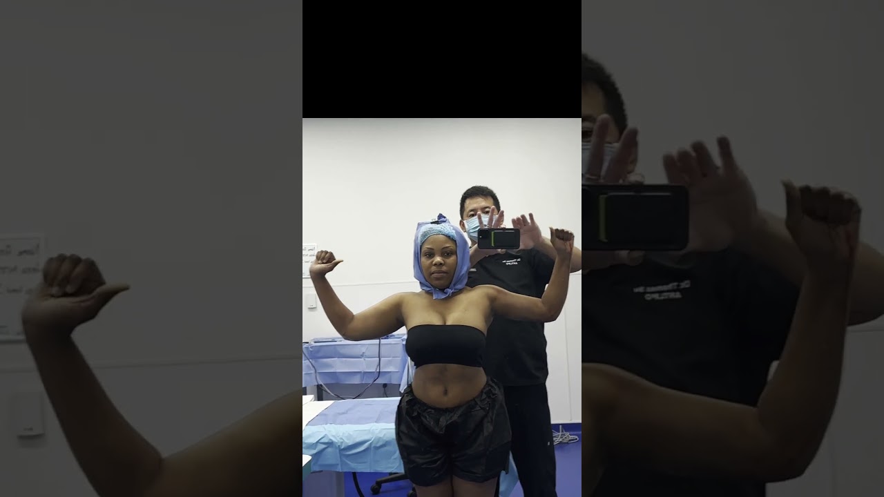 Celebrity Arms&trade; Before & After | Dr. Su&rsquo;s 360&deg; Awake Liposuction Transformation | Immediate Results!