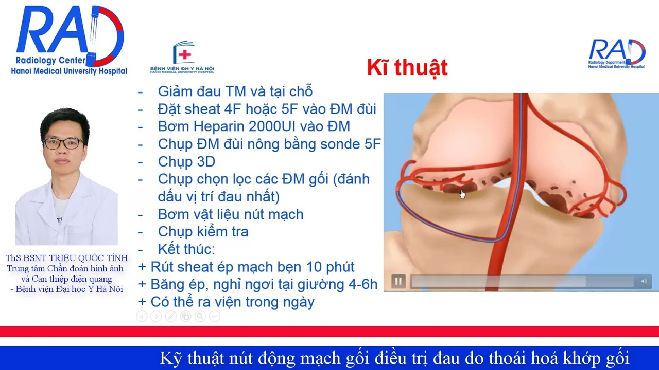Kỹ thuật nút động mạch gối điều trị đau do thoái hoá khớp gối