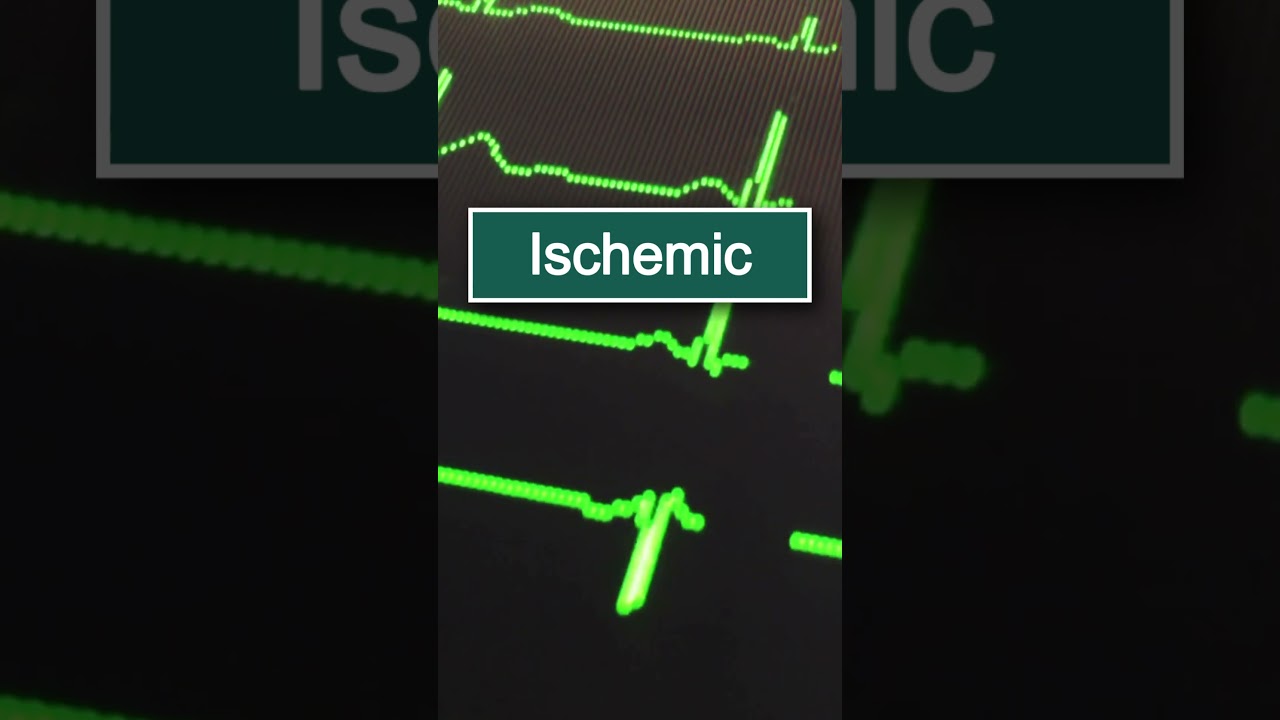 How to spot ischemia on an ECG: