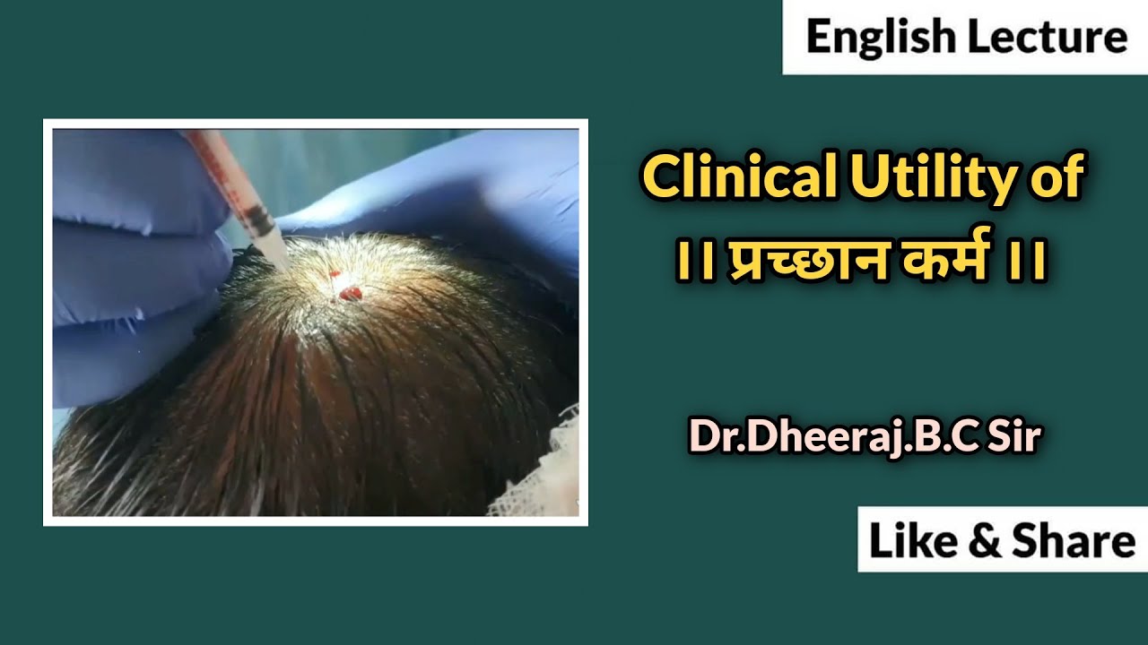 Clinical Utilization of Prachanna Karma By Dr.Dheeraj.B.C Sir Hassan Karnataka