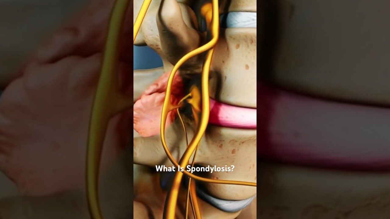 What Is Spondylosis?