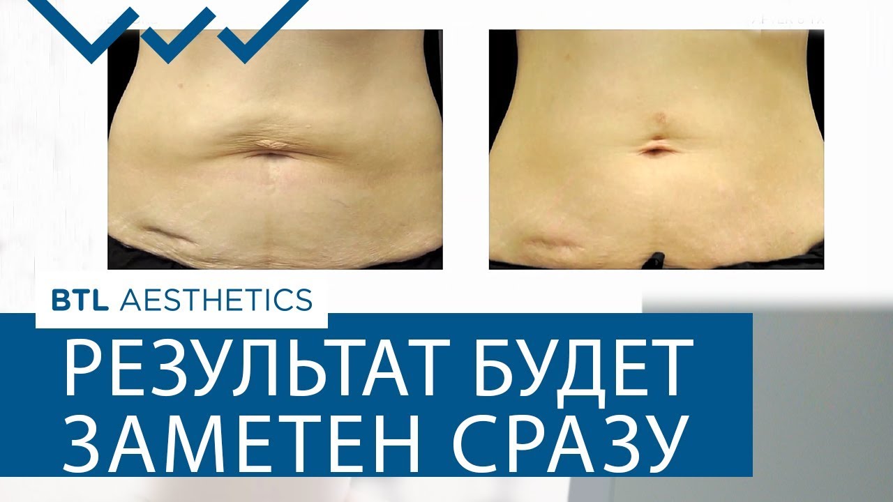 ☀  Мгновенный лифтинг кожи лица и тела с помощью EXILIS. EXILIS лифтинг. 12+