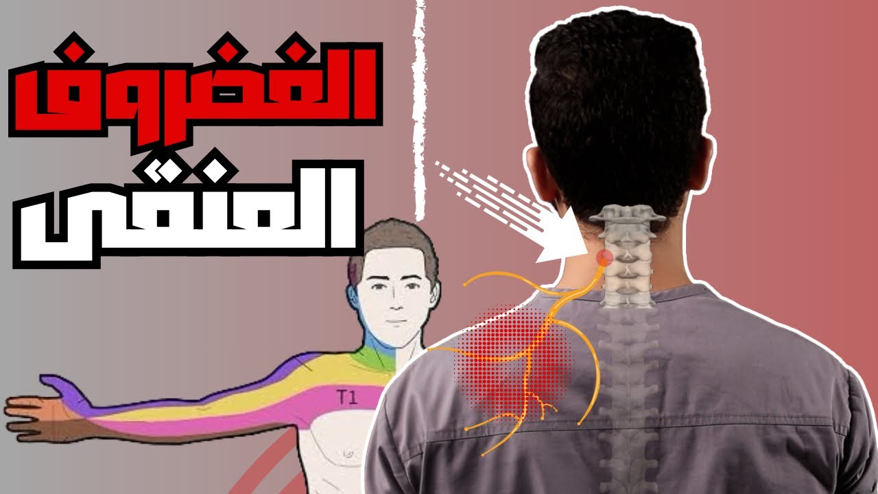 كل ما تحتاج أن تعرفه عن الانزلاق الغضروفي العنقي |الأسباب | التشخيص | أفضل 3 تمارين للعلاج نهائيا 💯