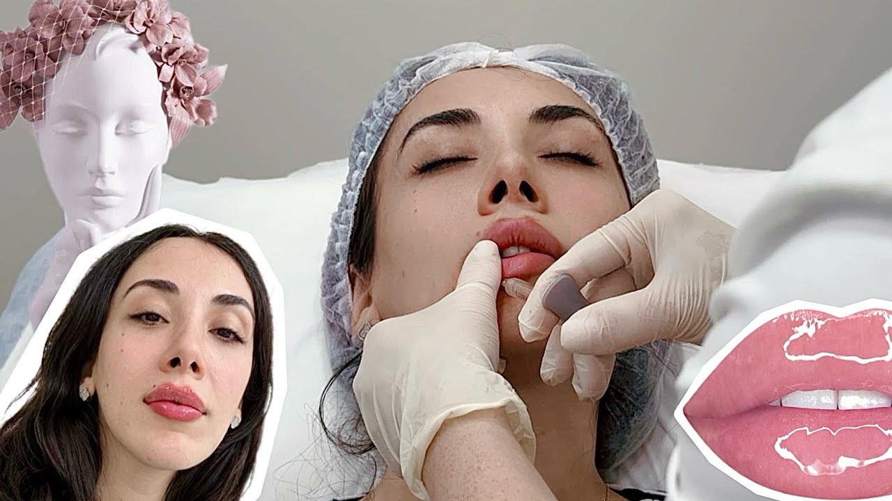 ტუჩები გავიდიდე🤭👄ტუჩის ფილერი 1მლ აბა როგორია? VLOG