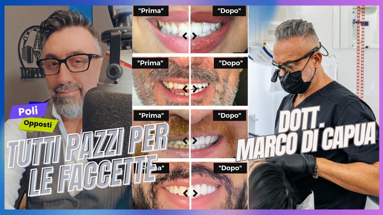 Tutti pazzi per le faccette dentali | Ne parlo con il noto Odontoiatra Marco Di Capua