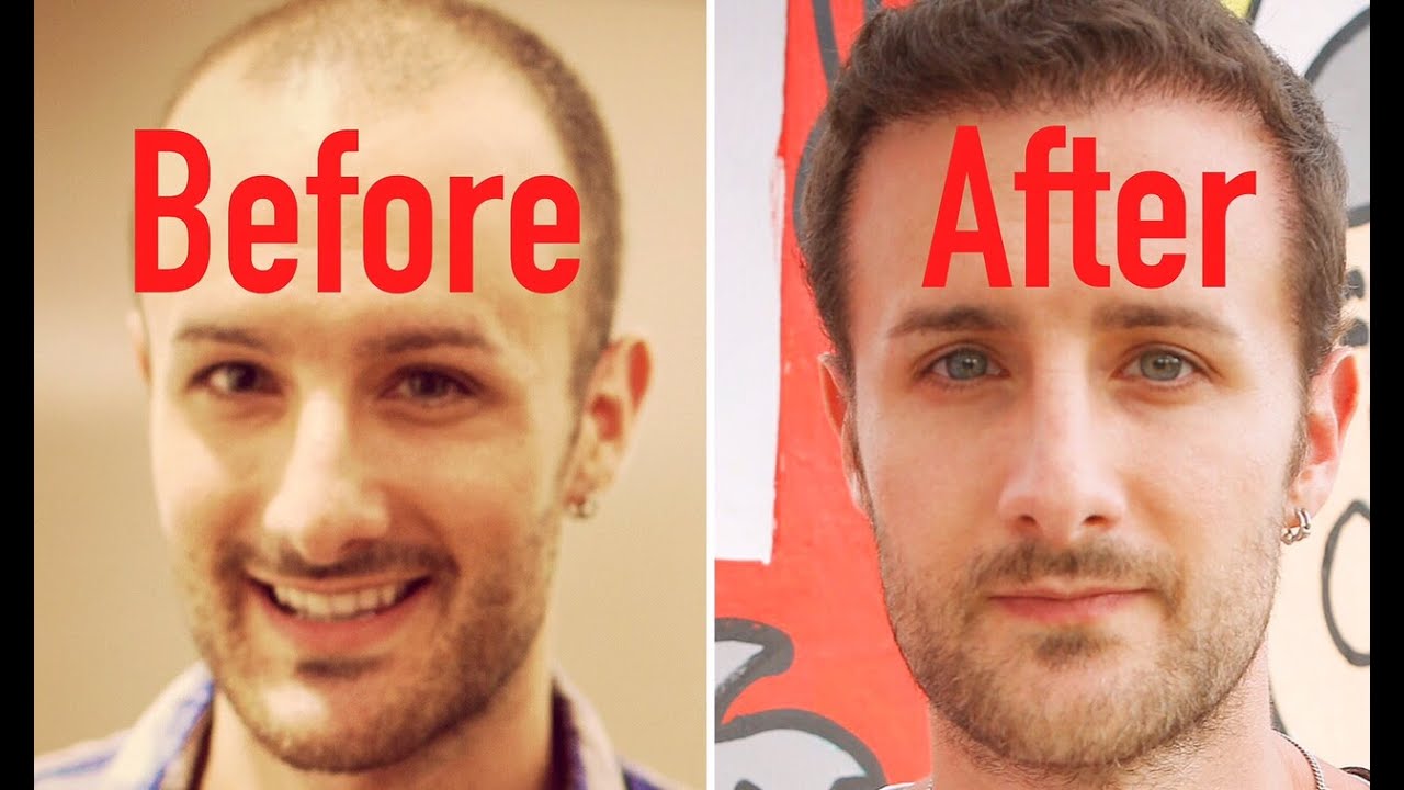 FUT vs. FUE - Hair Transplant FACTS ...You Probably Didn't Know