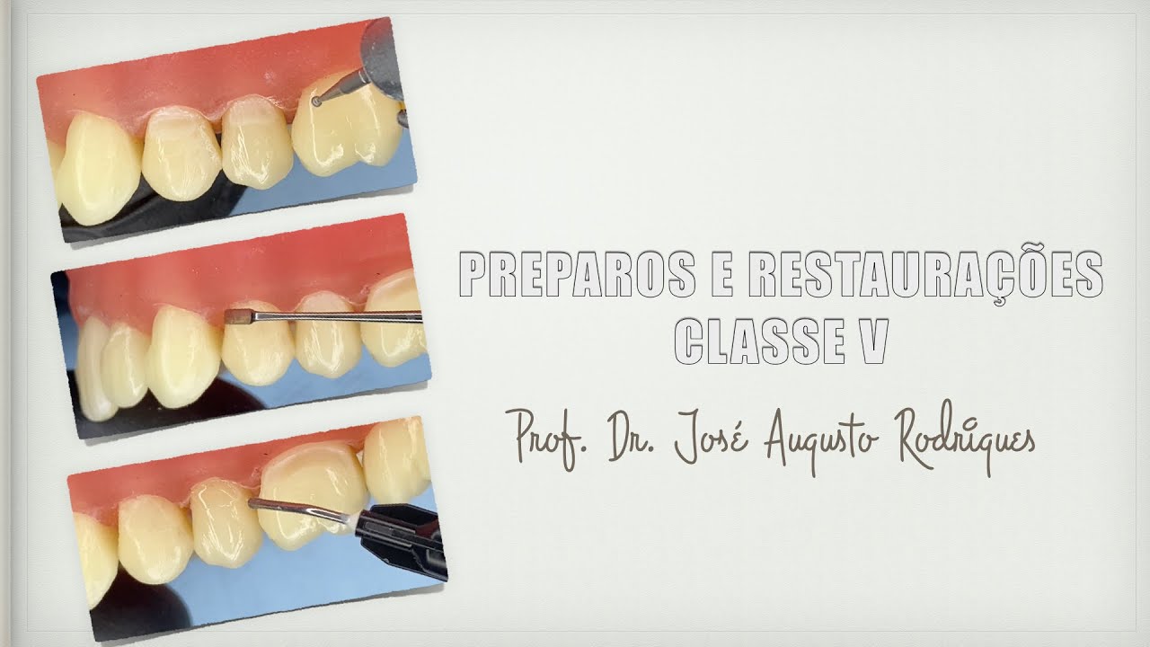 Preparos e restaurações Classe V