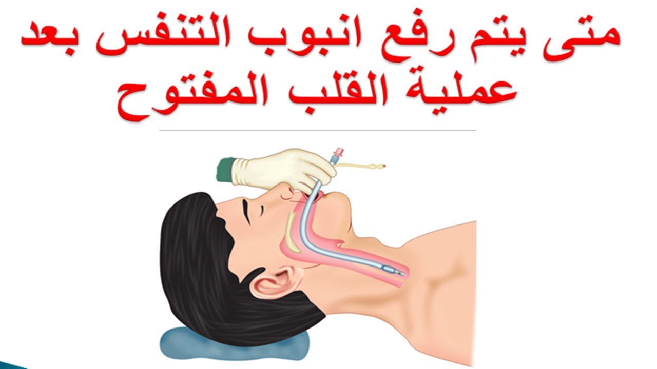 متى يتم رفع انبوب التنفس بعد عملية القلب المفتوح ؟ فصل مريض جراحة القلب المفتوح  جهاز التنفس الصناعي