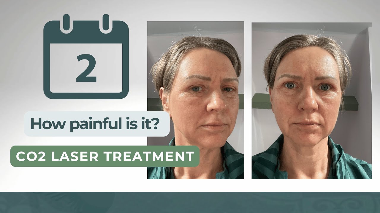 How Painful Is Day 2 After Co2 Laser Treatment?