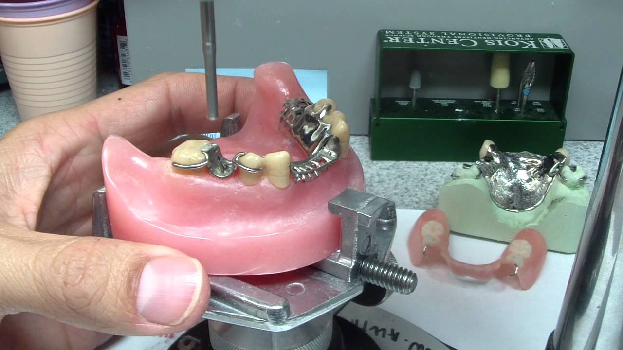 Partial Denture Designs