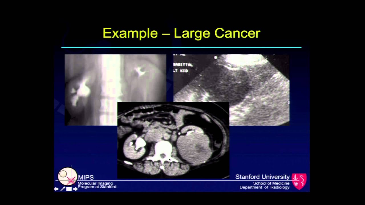 Imaging of Kidney Cancer Erik Mittra, M.D., PhD. Stanford University, Radiology