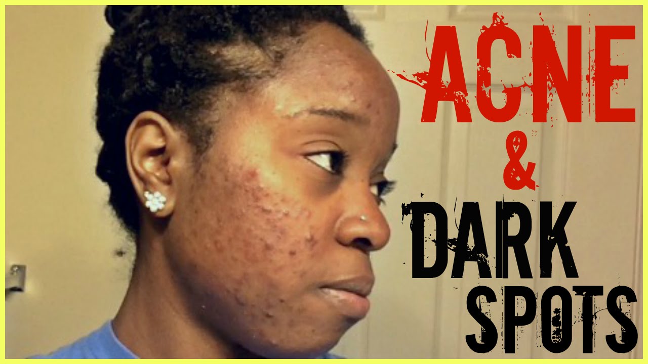 My Emotional Acne Journey + How I Cleared My Adult Acne