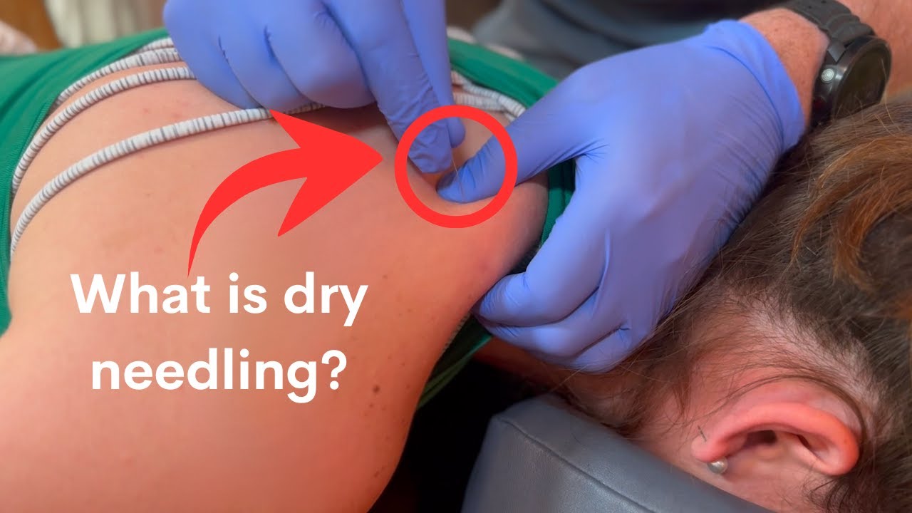 What Is Dry Needling?