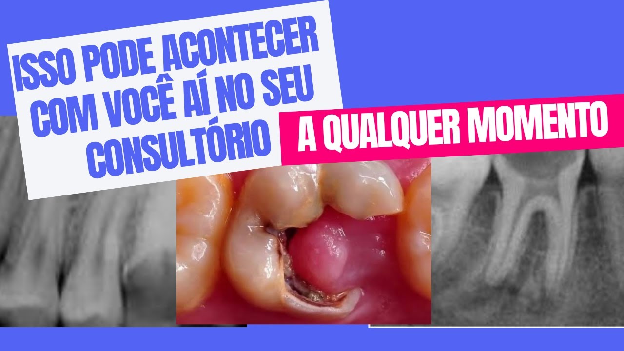 O que é PÓLIPO PULPAR  ou 