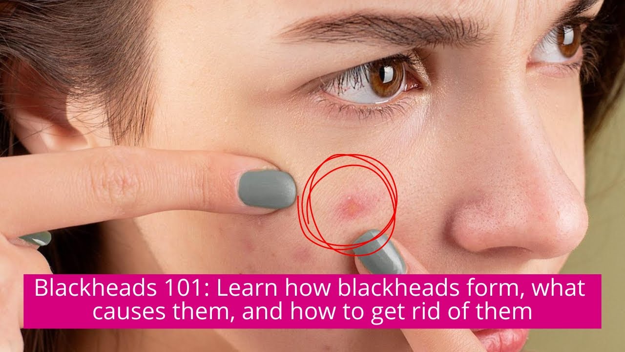 Blackheads 101: Learn how blackheads form, what causes them, and how to get rid of them