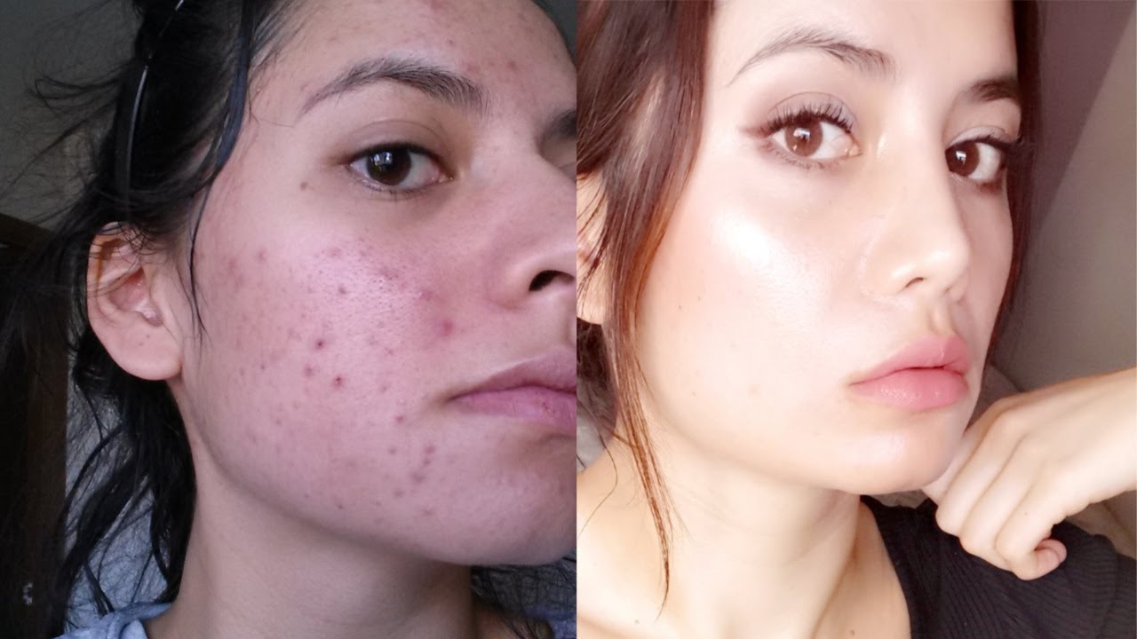 Tretinoin Before and After (12 Tips To Get The BEST RESULTS)