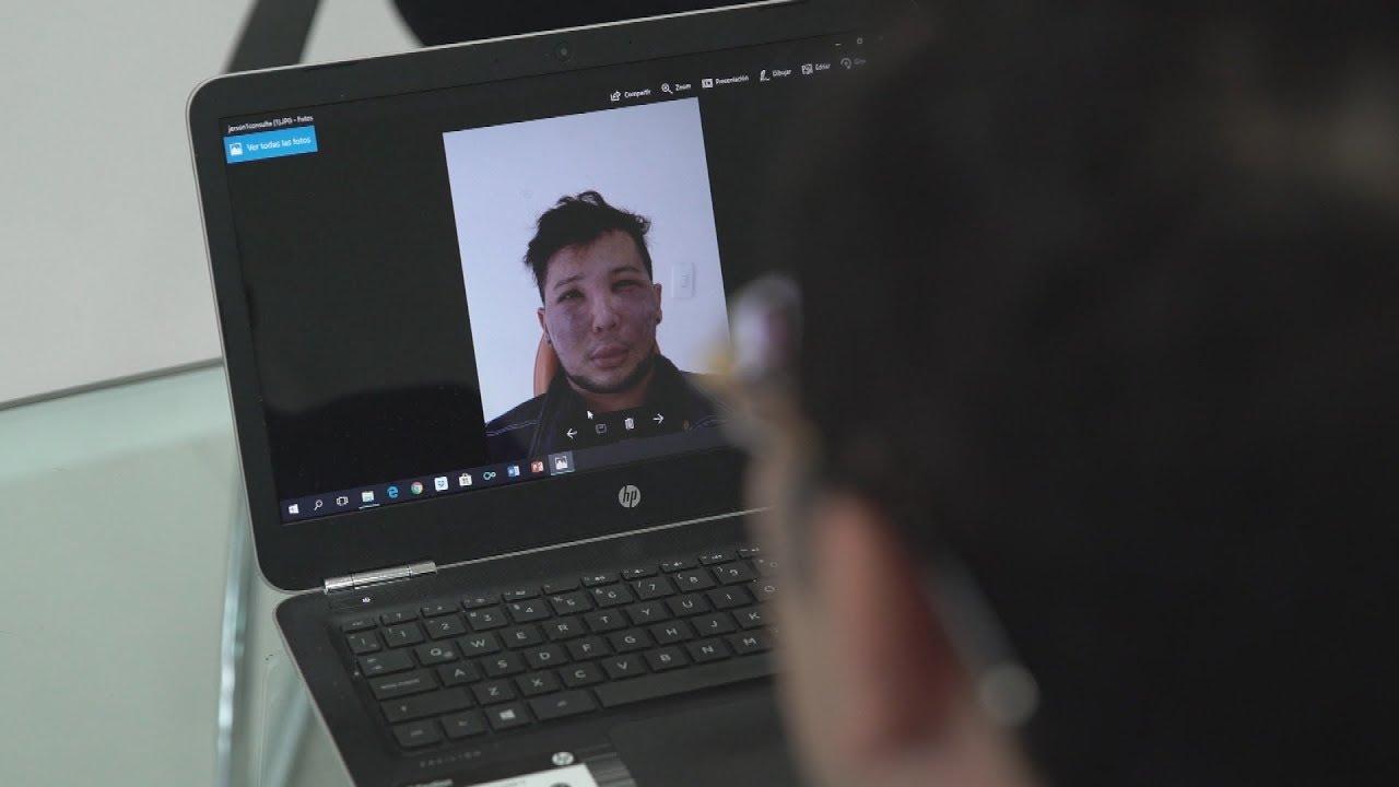 Cosmetic surgery can come at a high cost in Colombia